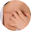 Sweat Rash